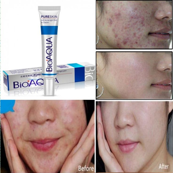 BIOAQUA Acne Fighter - Blemish & Scar Cream